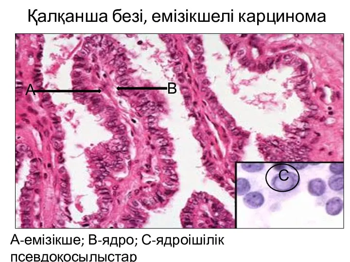 Қалқанша безі, емізікшелі карцинома А-емізікше; В-ядро; С-ядроішілік псевдоқосылыстар А В С