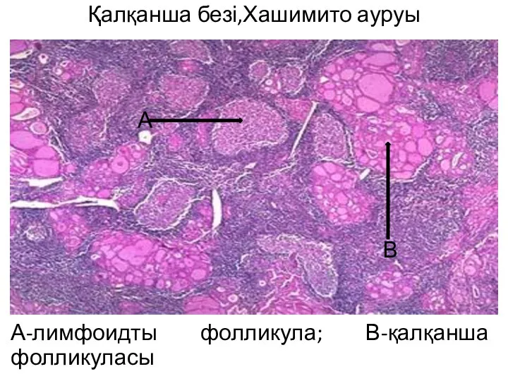 Қалқанша безі,Хашимито ауруы А-лимфоидты фолликула; В-қалқанша фолликуласы А В