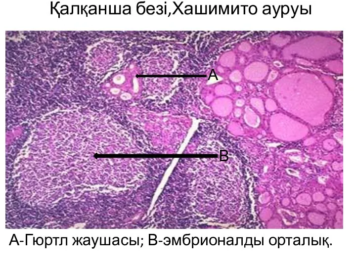 Қалқанша безі,Хашимито ауруы А-Гюртл жаушасы; В-эмбрионалды орталық. А В