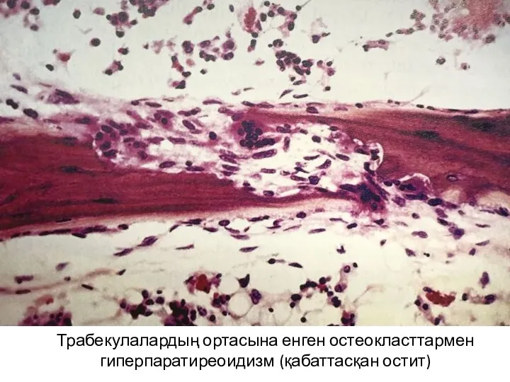 Трабекулалардың ортасына енген остеокласттармен гиперпаратиреоидизм (қабаттасқан остит)