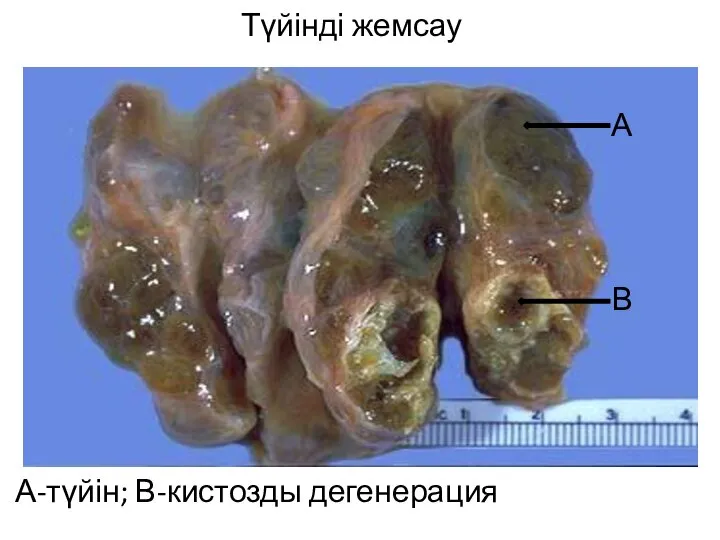 Түйінді жемсау А-түйін; В-кистозды дегенерация В А