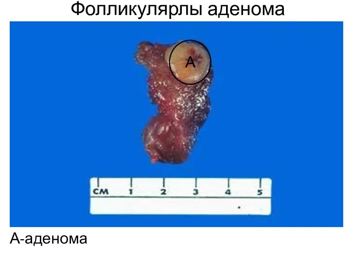 Фолликулярлы аденома А-аденома А