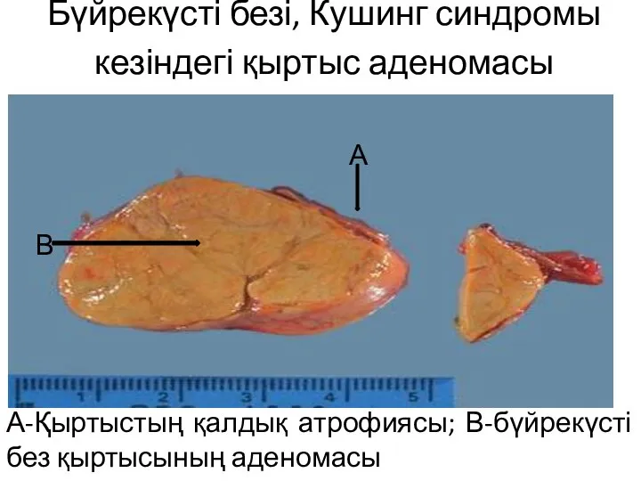 Бүйрекүсті безі, Кушинг синдромы кезіндегі қыртыс аденомасы А-Қыртыстың қалдық атрофиясы; В-бүйрекүсті без қыртысының аденомасы А В