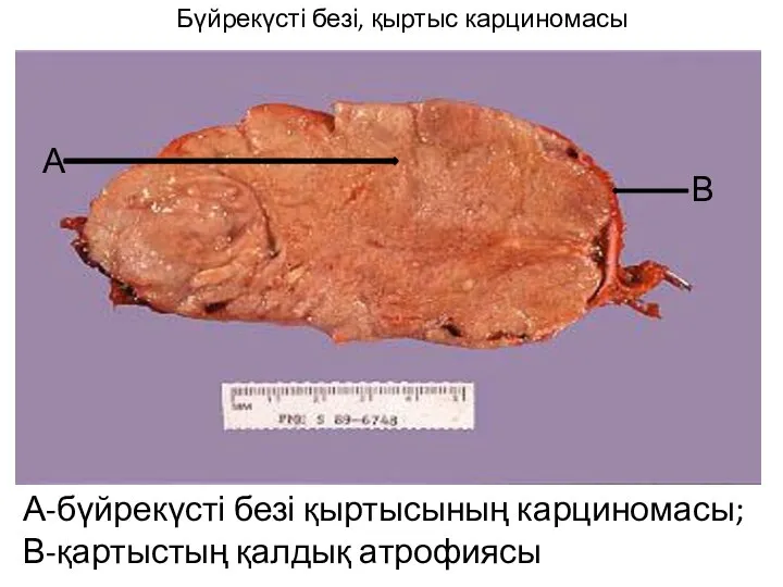 Бүйрекүсті безі, қыртыс карциномасы А-бүйрекүсті безі қыртысының карциномасы; В-қартыстың қалдық атрофиясы А В