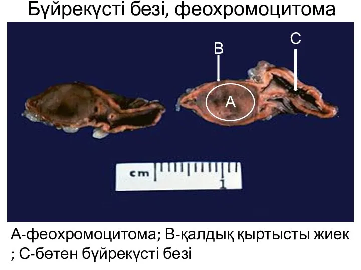 Бүйрекүсті безі, феохромоцитома А-феохромоцитома; В-қалдық қыртысты жиек ; С-бөтен бүйрекүсті безі А В С