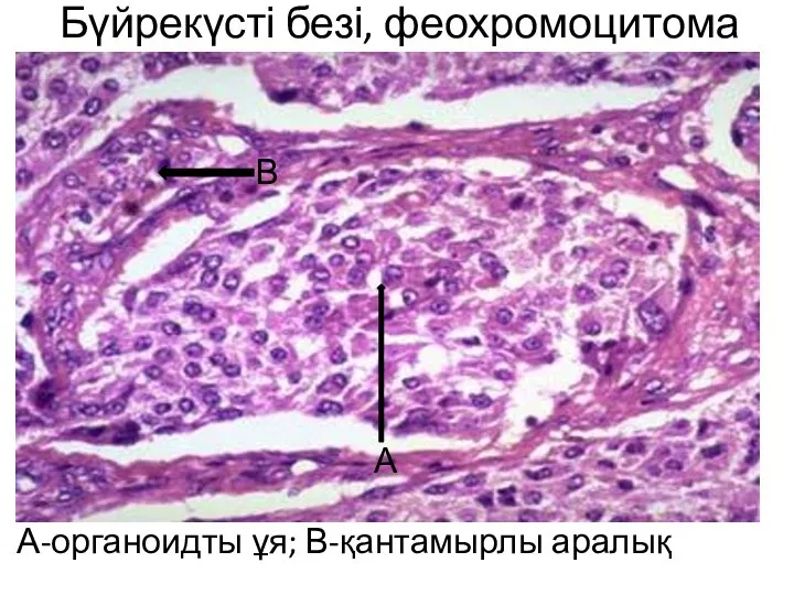 Бүйрекүсті безі, феохромоцитома А-органоидты ұя; В-қантамырлы аралық А В