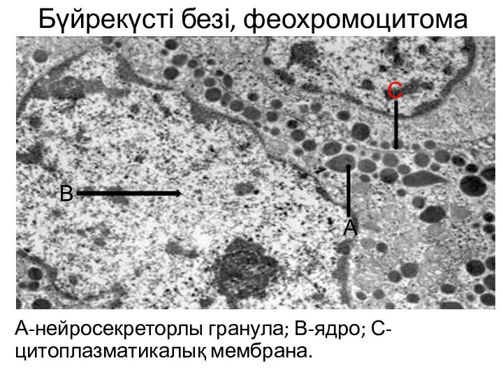 Бүйрекүсті безі, феохромоцитома А-нейросекреторлы гранула; В-ядро; С-цитоплазматикалық мембрана. А В С