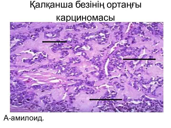 Қалқанша безінің ортаңғы карциномасы А-амилоид.