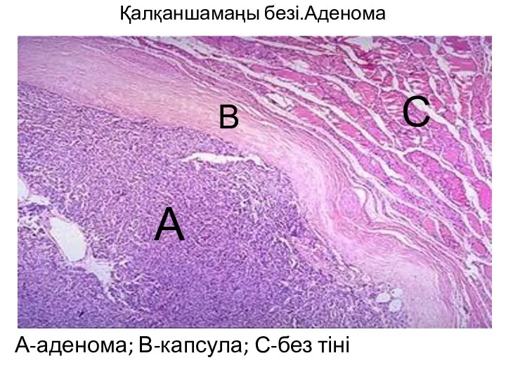 Қалқаншамаңы безі.Аденома А-аденома; В-капсула; С-без тіні А В С