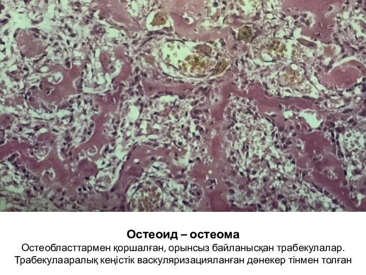 Остеоид – остеома Остеобласттармен қоршалған, орынсыз байланысқан трабекулалар. Трабекулааралық кеңістік васкуляризацияланған дәнекер тінмен толған