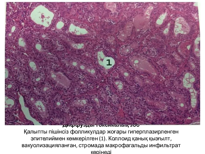 Диффузды токсикалық зоб Қалыпты пішінсіз фолликулдар жоғары гиперплазирленген эпителиймен көмкерілген (1).