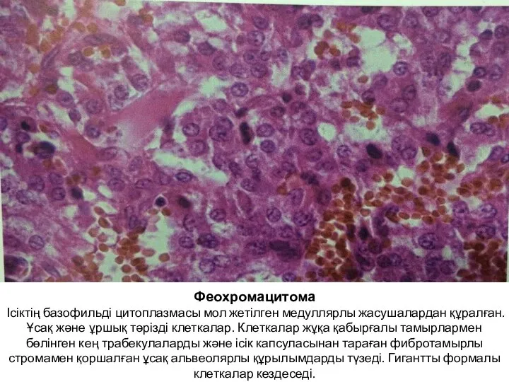 Феохромацитома Ісіктің базофильді цитоплазмасы мол жетілген медуллярлы жасушалардан құралған. Ұсақ және