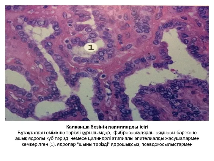 Қалқанша безінің папиллярлы ісігі Бұтақталған емізікше тәрізді құрылымдар, фиброваскулярлы аяқшасы бар