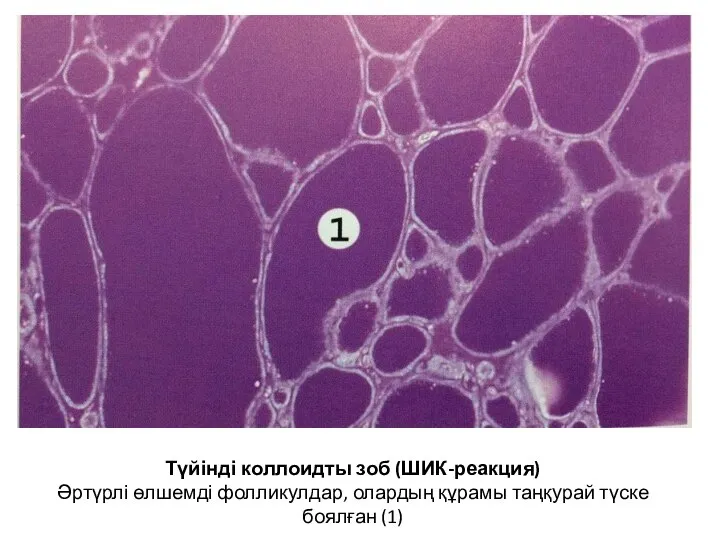Түйінді коллоидты зоб (ШИК-реакция) Әртүрлі өлшемді фолликулдар, олардың құрамы таңқурай түске боялған (1)