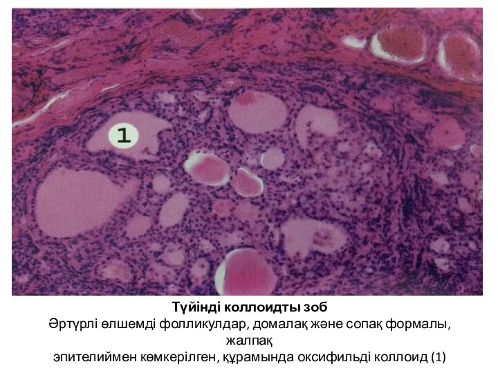 Түйінді коллоидты зоб Әртүрлі өлшемді фолликулдар, домалақ және сопақ формалы, жалпақ