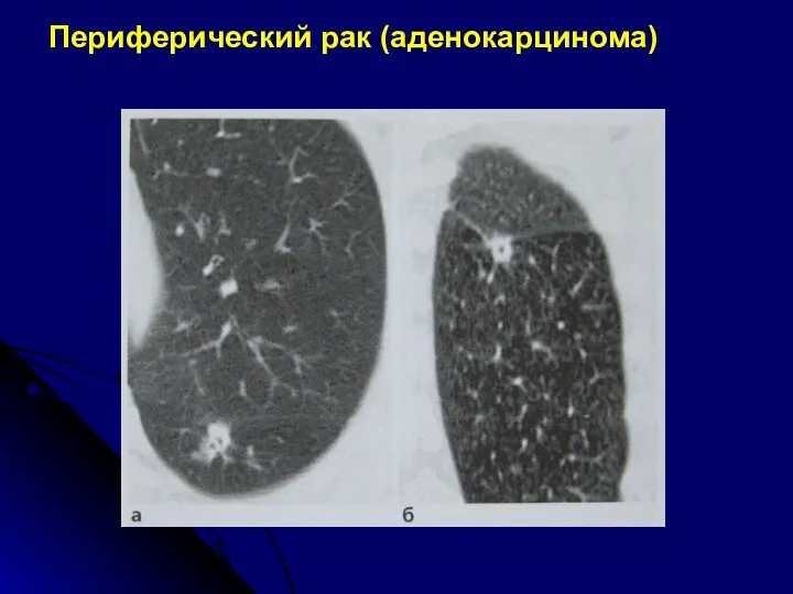 Периферический рак (аденокарцинома)