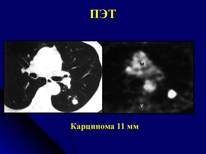 Карцинома 11 мм ПЭТ