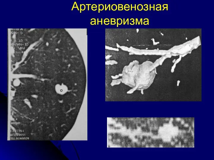 Артериовенозная аневризма