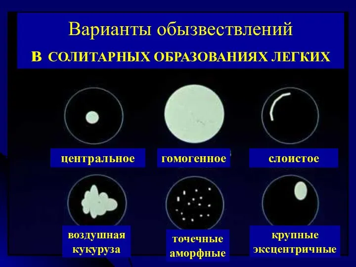 Варианты обызвествлений в СОЛИТАРНЫХ ОБРАЗОВАНИЯХ ЛЕГКИХ центральное гомогенное слоистое воздушная кукуруза точечные аморфные крупные экcцентричные