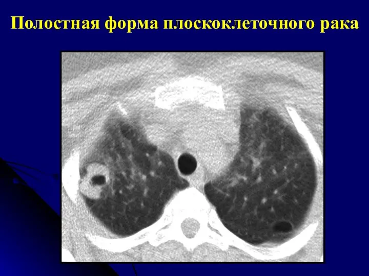 Полостная форма плоскоклеточного рака