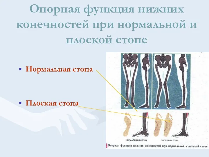 Опорная функция нижних конечностей при нормальной и плоской стопе Нормальная стопа Плоская стопа