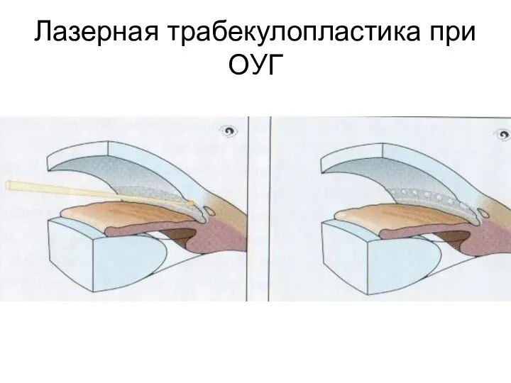 Лазерная трабекулопластика при ОУГ