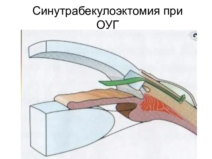 Синутрабекулоэктомия при ОУГ