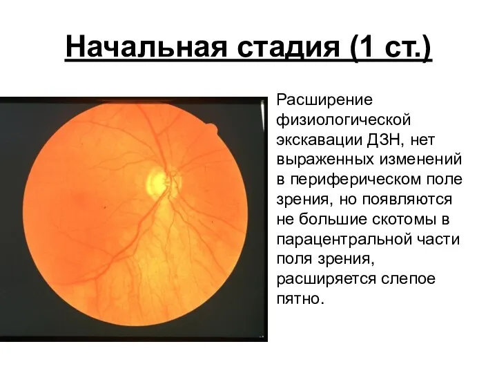 Начальная стадия (1 ст.) Расширение физиологической экскавации ДЗН, нет выраженных изменений