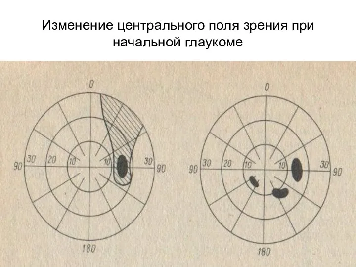 Изменение центрального поля зрения при начальной глаукоме