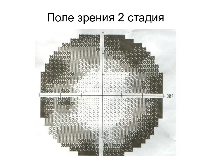 Поле зрения 2 стадия