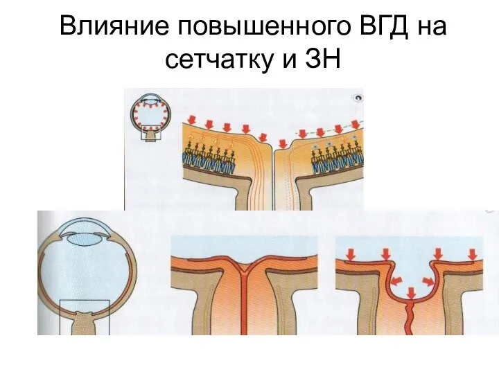 Влияние повышенного ВГД на сетчатку и ЗН