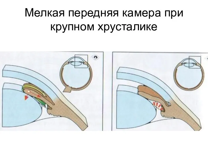 Мелкая передняя камера при крупном хрусталике