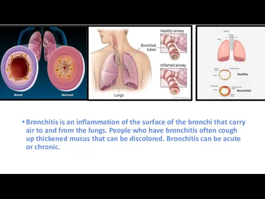 Bronchitis is an inflammation of the surface of the bronchi that