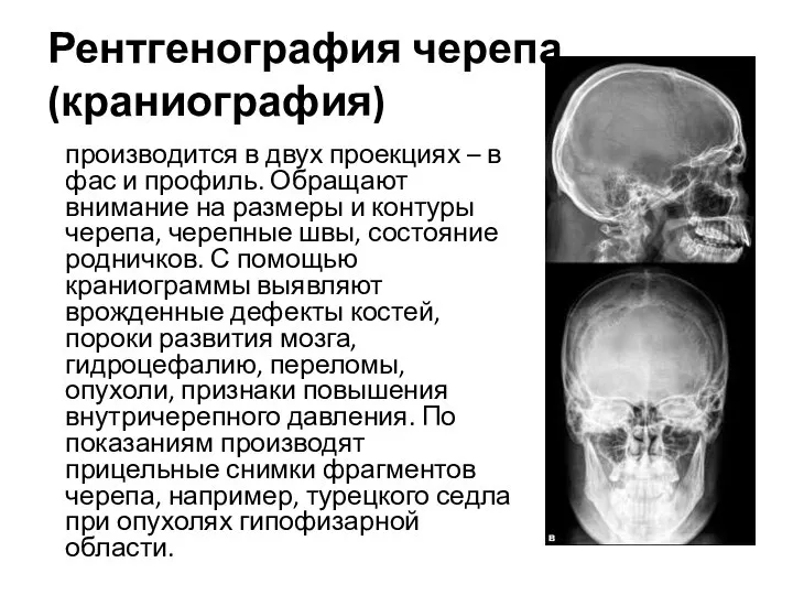 Рентгенография черепа (краниография) производится в двух проекциях – в фас и