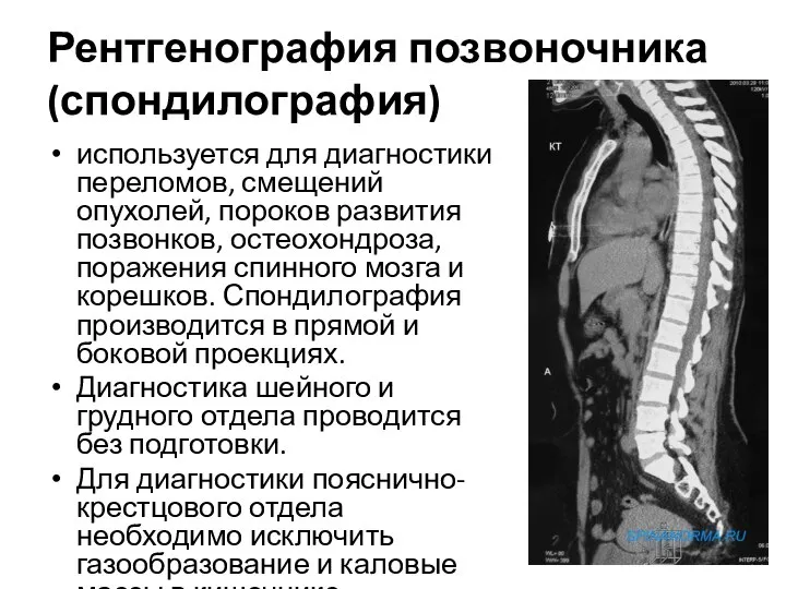 Рентгенография позвоночника (спондилография) используется для диагностики переломов, смещений опухолей, пороков развития