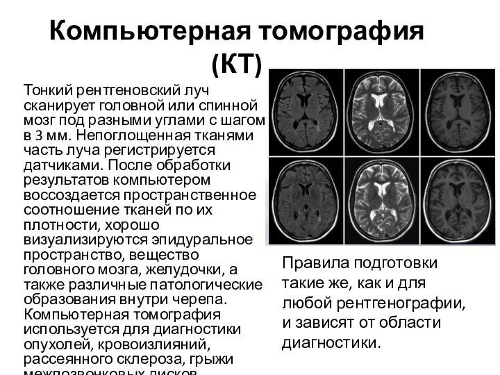 Компьютерная томография (КТ) Тонкий рентгеновский луч сканирует головной или спинной мозг