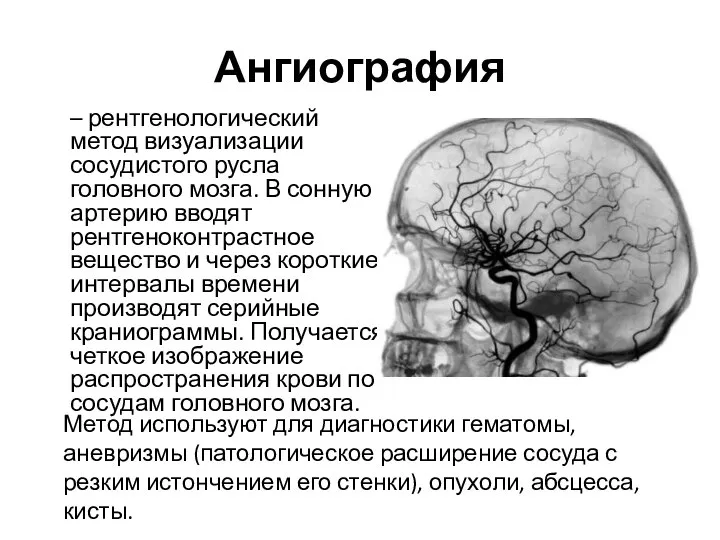 Ангиография – рентгенологический метод визуализации сосудистого русла головного мозга. В сонную