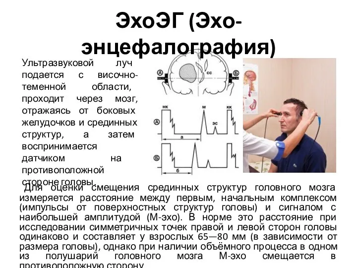 ЭхоЭГ (Эхо-энцефалография) Для оценки смещения срединных структур головного мозга измеряется расстояние