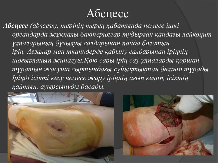 Абсцесс Абсцесс (abscess), терінің терең қабатында немесе ішкі органдарда жұқпалы бактериялар