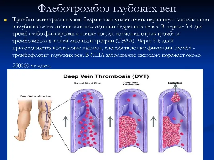 Флеботромбоз глубоких вен Тромбоз магистральных вен бедра и таза может иметь