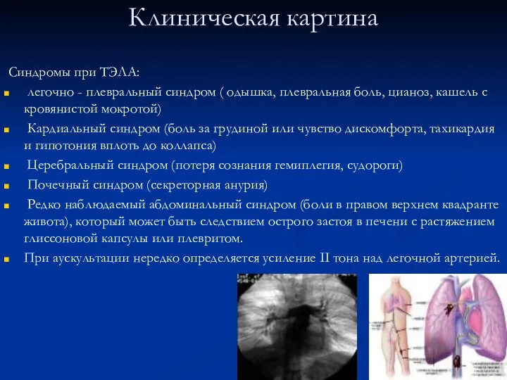 Клиническая картина Синдромы при ТЭЛА: легочно - плевральный синдром ( одышка,