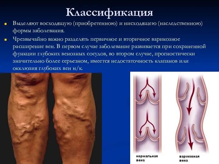 Классификация Выделяют восходящую (приобретенною) и нисходящею (наследственною) формы заболевания. Чрезвычайно важно