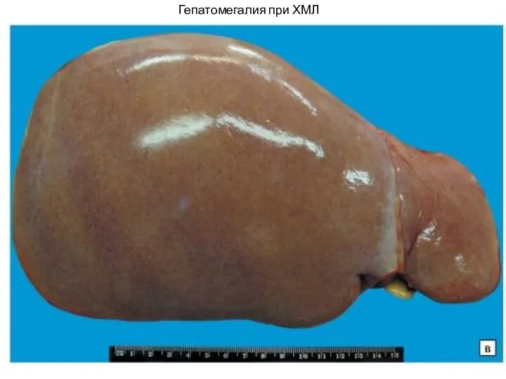 Гепатомегалия при ХМЛ