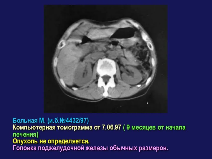 Больная М. (и.б.№4432/97) Компьютерная томограмма от 7.06.97 ( 9 месяцев от