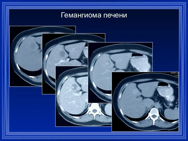 Гемангиома печени