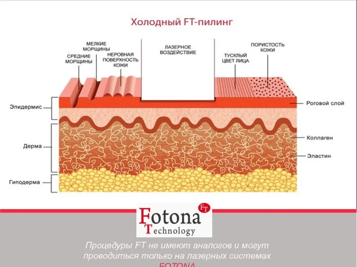 Процедуры FT не имеют аналогов и могут проводиться только на лазерных системах FOTONA