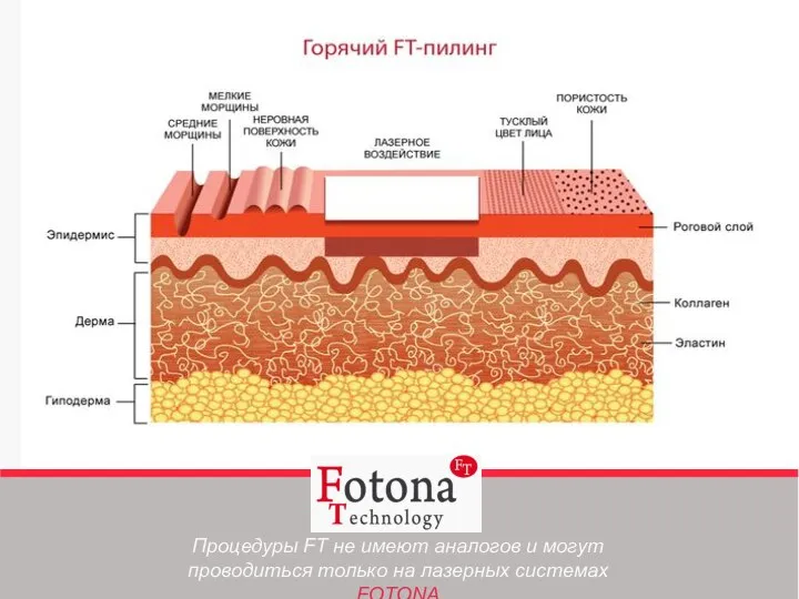 Процедуры FT не имеют аналогов и могут проводиться только на лазерных системах FOTONA
