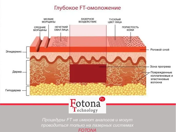 Процедуры FT не имеют аналогов и могут проводиться только на лазерных системах FOTONA