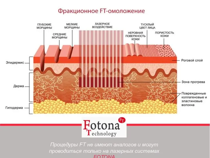 Процедуры FT не имеют аналогов и могут проводиться только на лазерных системах FOTONA