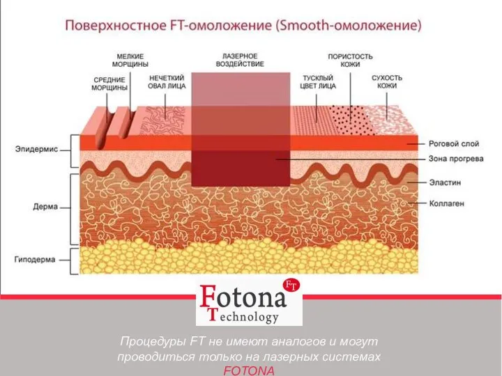 Процедуры FT не имеют аналогов и могут проводиться только на лазерных системах FOTONA